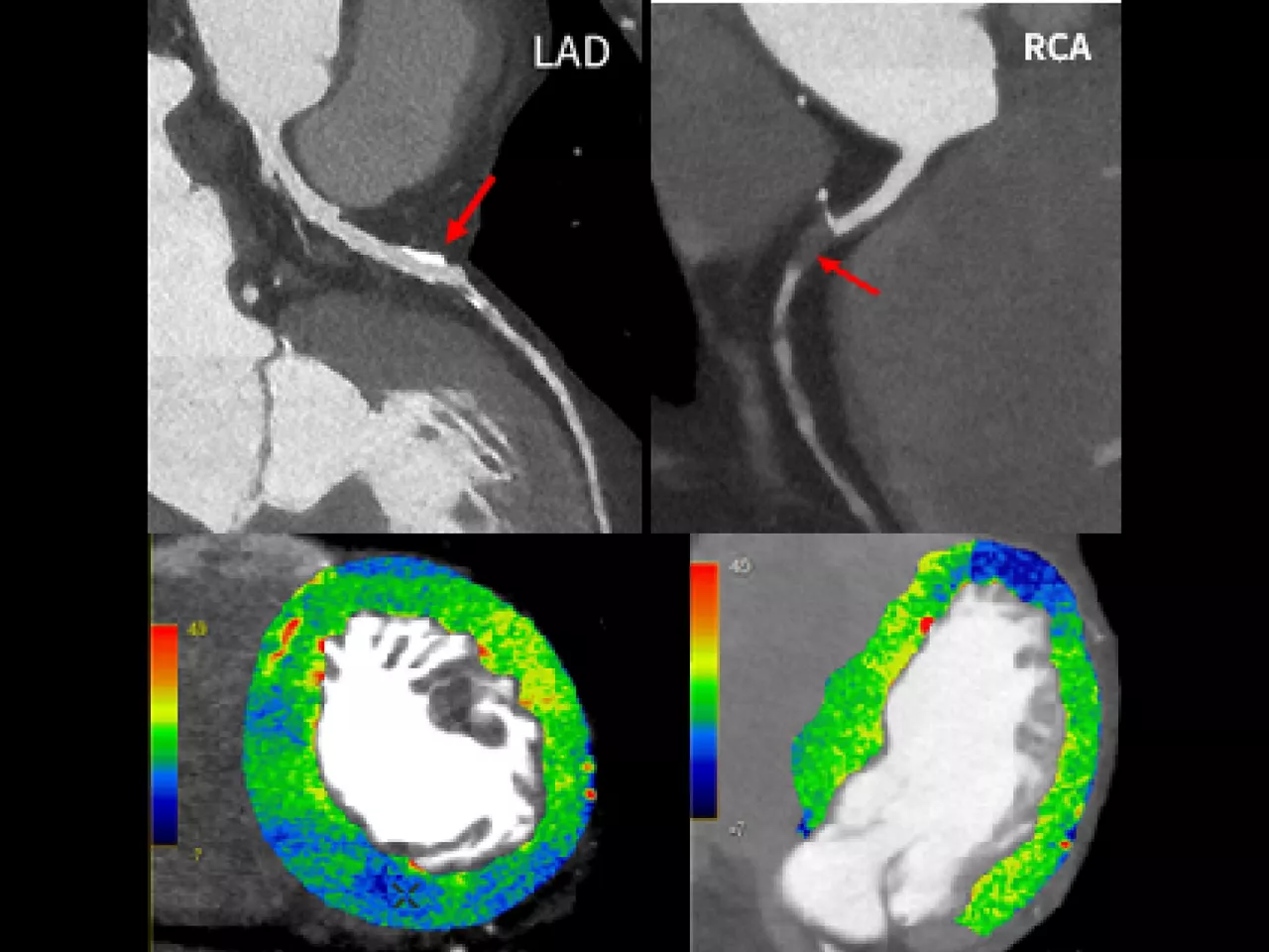 cardiac-ct-spectral-imaging-high-resolution
