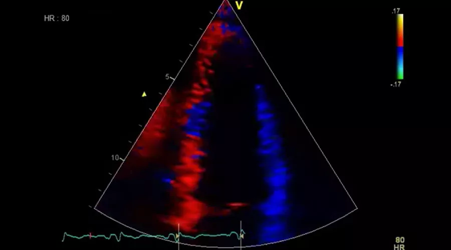 Tissue Velocity Imaging