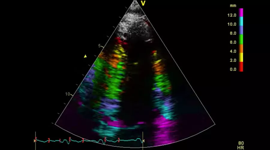 Tissue Tracking* / Tissue Synchronization Imaging*