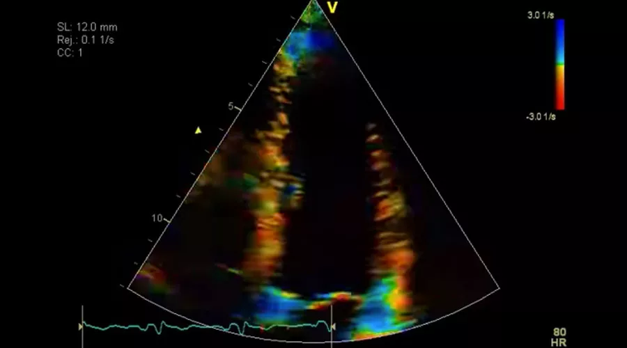 Strain* / Strain Rate Imaging*