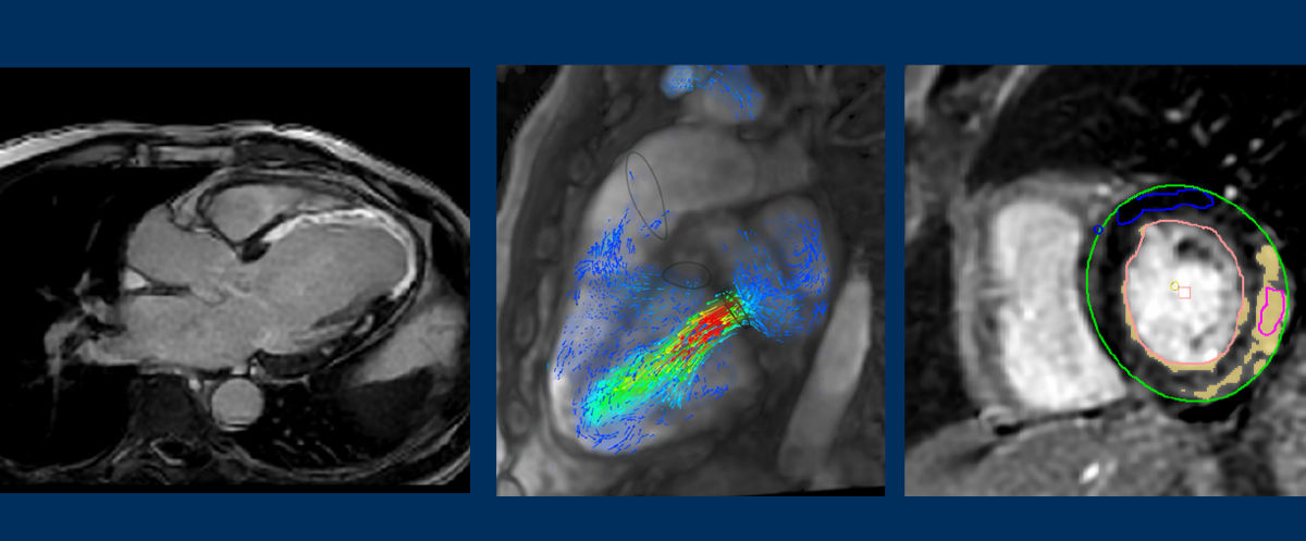 cardiac_magnetic_resonance_imaging