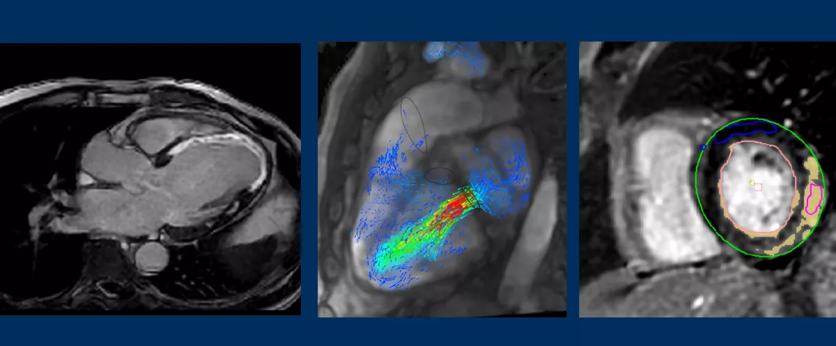 cardiac_magnetic_resonance_imaging