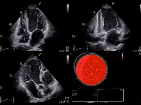 Cardiology Solutions Acute Coronary Syndrome AFI Image25