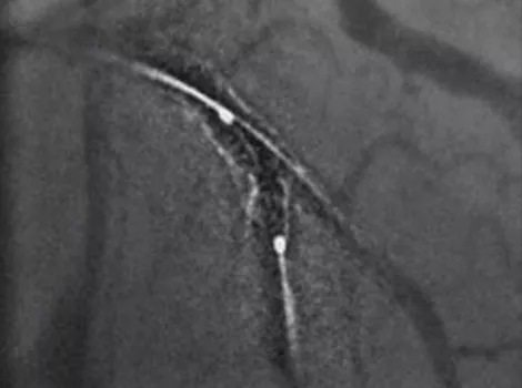Cardiology Solutions Acute Coronary Syndrome PCI assist