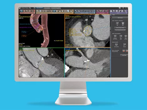 Cardiology Solutions Aortic Stenosis aw tavi