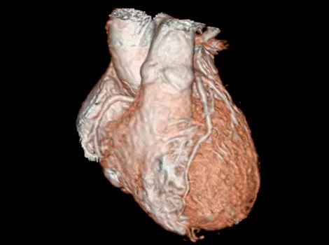 Cardiology Solutions Aortic Stenosis signaworks 1and 2