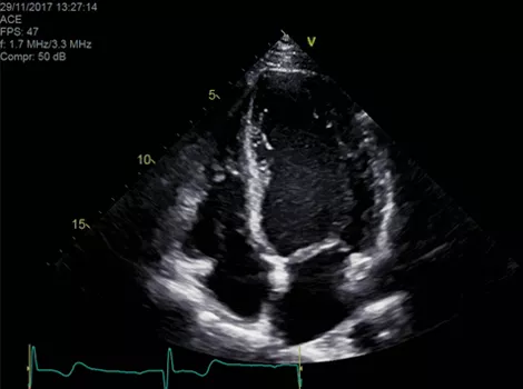 Cardiology Solutions Aortic Stenosis vivid e95 clinical 2d
