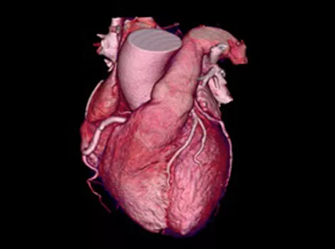 Cardiology Solutions Atrial Fibrillation revolution cardiographe