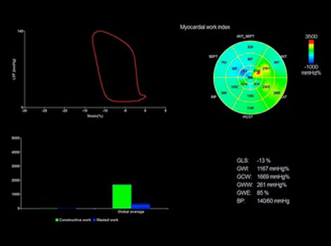 Cardiology Solutions Atrial Fibrillation ve95 m5Sc myocardialWork