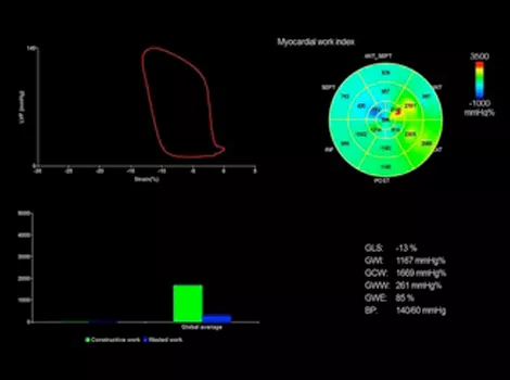 Cardiology Solutions Atrial Fibrillation ve95 m5Sc myocardialWork