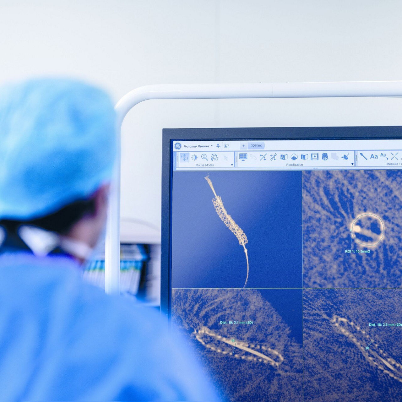 3D Stent
