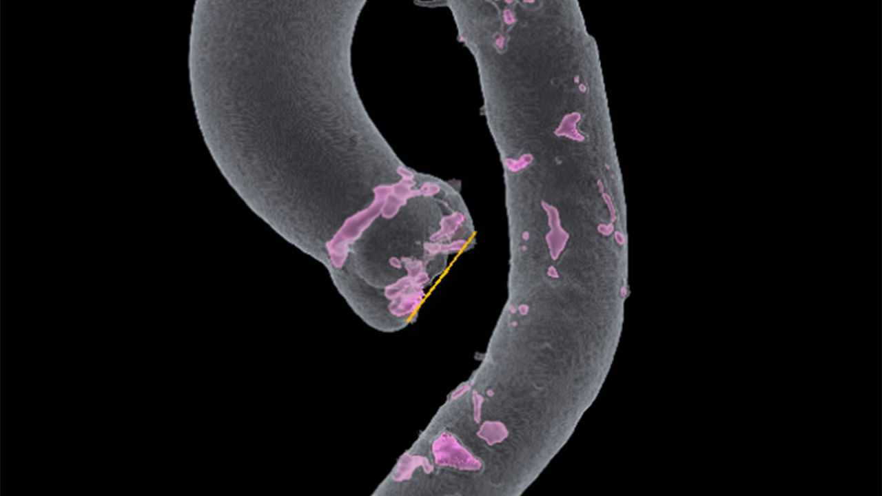 <p>TAVI Analysis</p>
