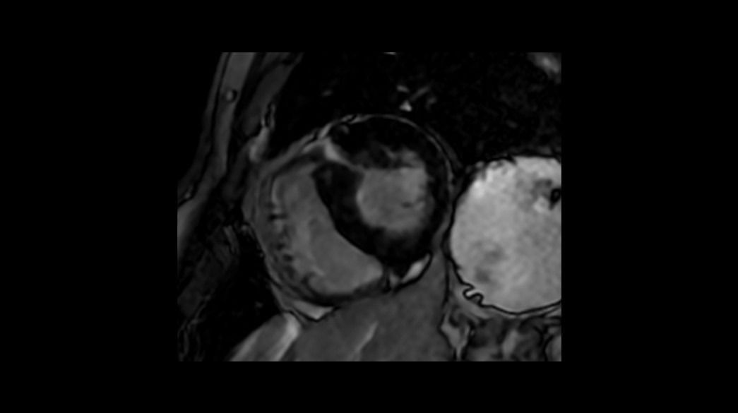 <p>SSH (PS) MDE with Respiratory Triggering – compatible with AIR™ Recon DL</p>
