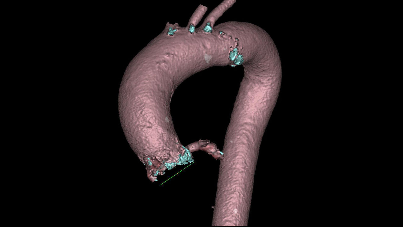 cations-valveplanning-valve-planning-clinical-valve-plan-automatic-optimal-projection