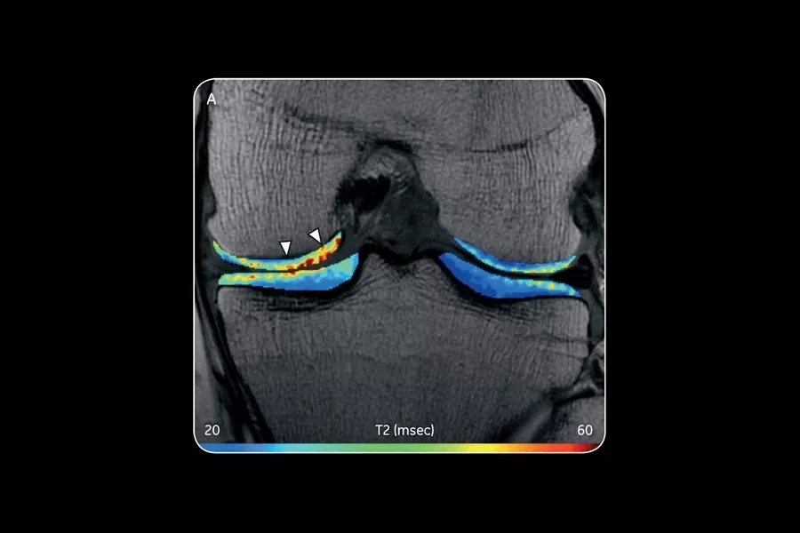 Characterizingcartilagebeforeandaftersurgery
