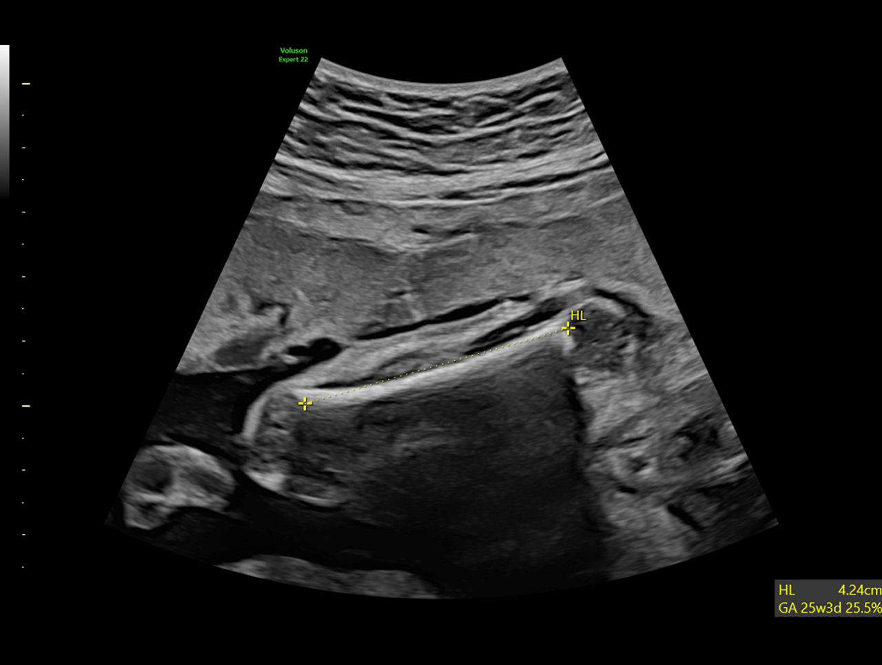 Clinical-Image-of-SonoBiometery