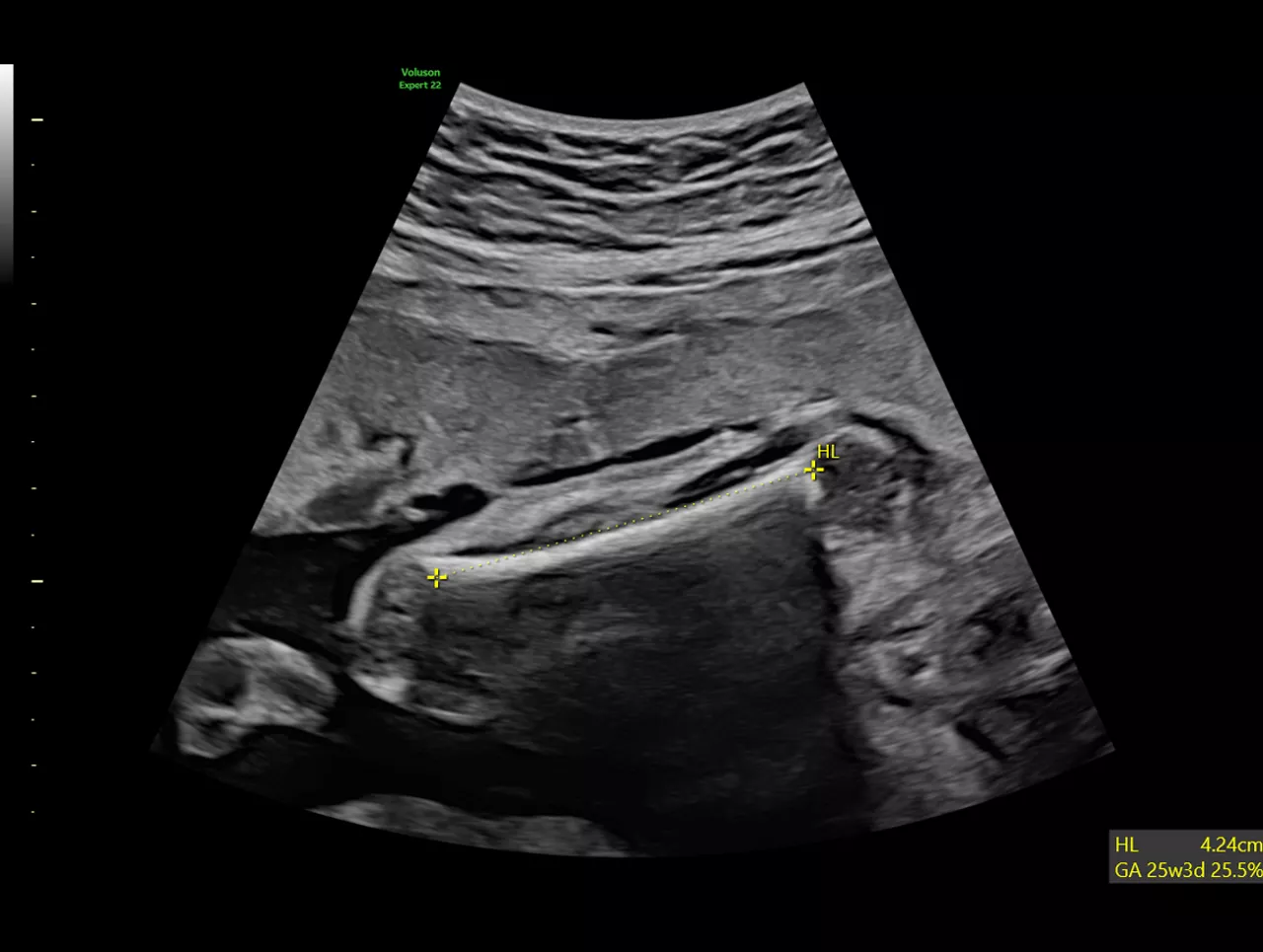 Clinical-Image-of-SonoBiometery