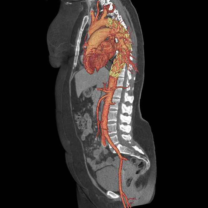 clinicalimagescardiovasculargehcrevolutionctcardiovascularcinicalwholeaorta2