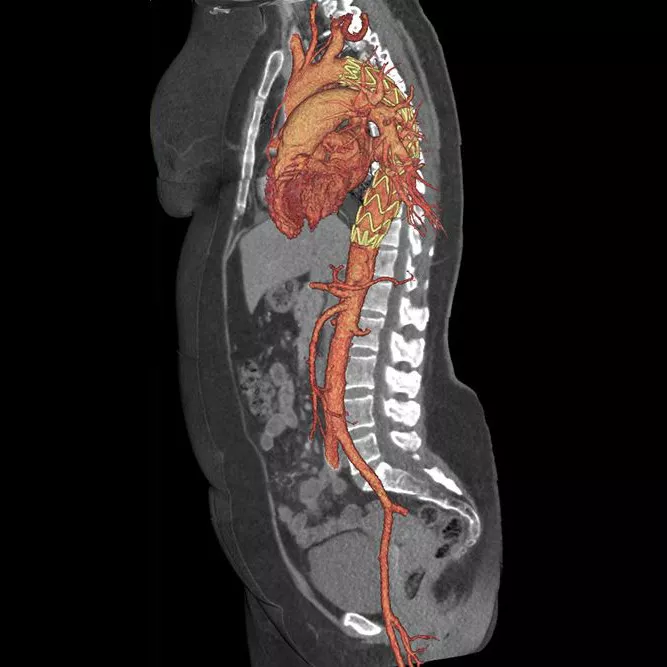 clinicalimagescardiovasculargehcrevolutionctcardiovascularcinicalwholeaorta2