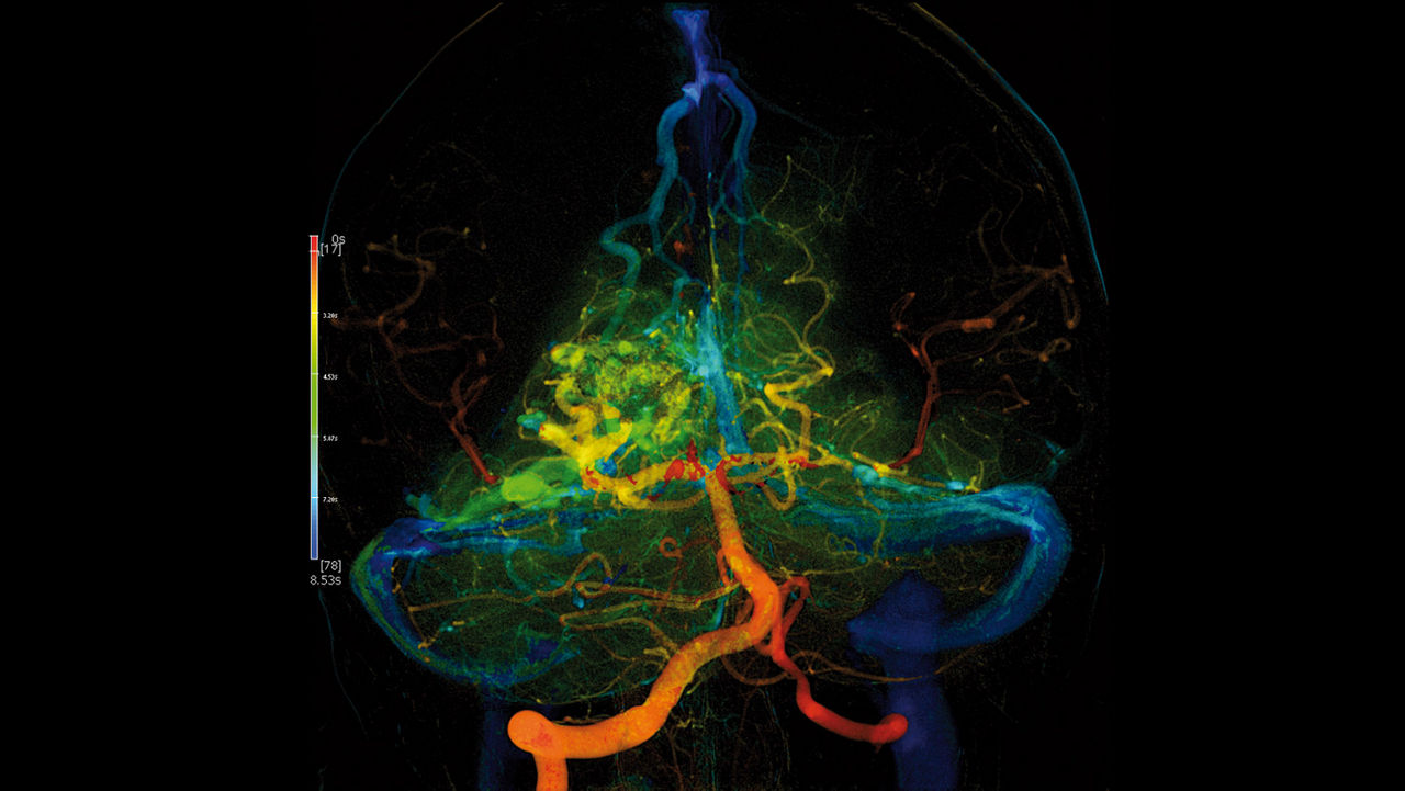 clone-advanced-visualization-applications-angioviz-clinical-aw-angioviz-clinical-thumb