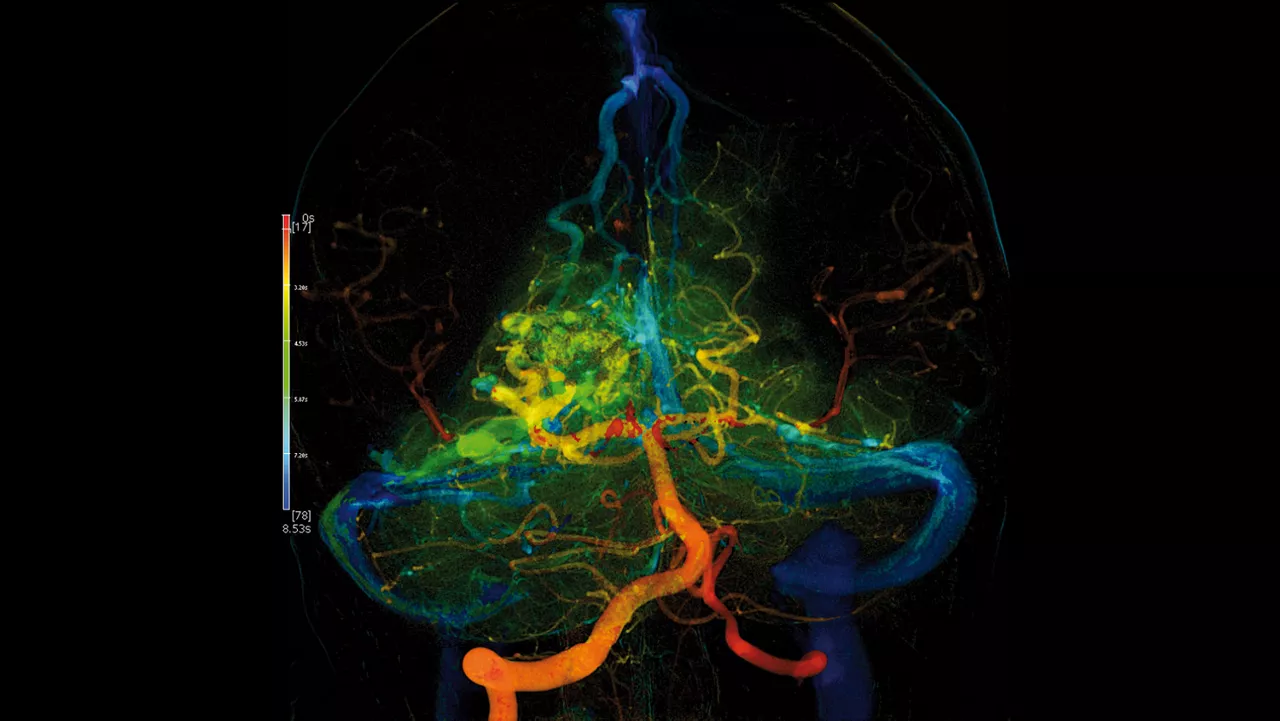clone-advanced-visualization-applications-angioviz-clinical-aw-angioviz-clinical-thumb