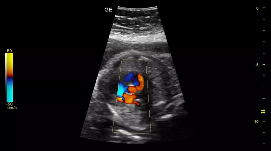 color-doppler
