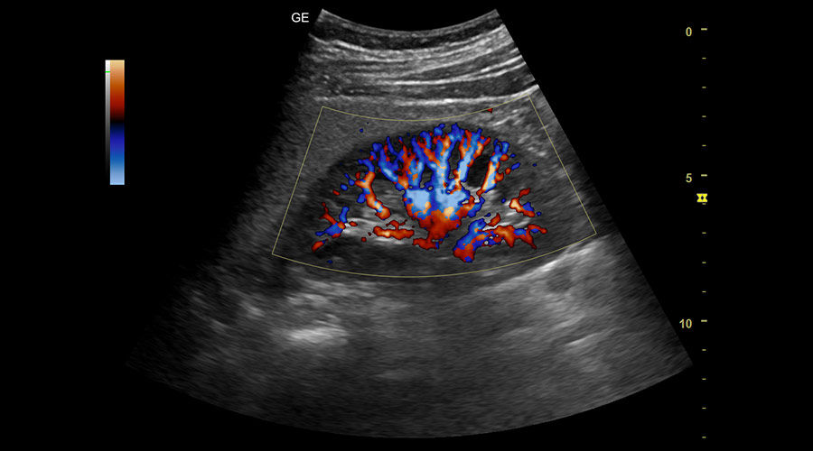 color-doppler