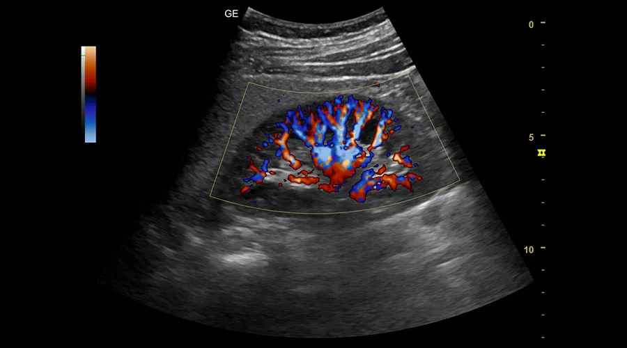 color-doppler