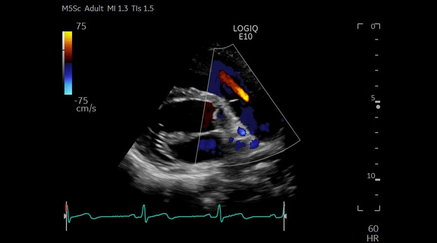 COLOR-THROUGH-PULMONIC-VALVE-M5Sc-D_900x500