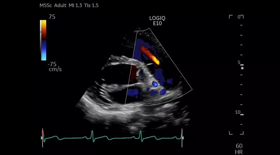 COLOR-THROUGH-PULMONIC-VALVE-M5Sc-D_900x500