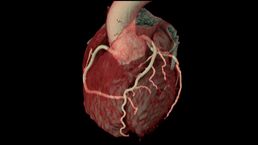 computed-tomography-feature-card-ecg-less-ba-en
