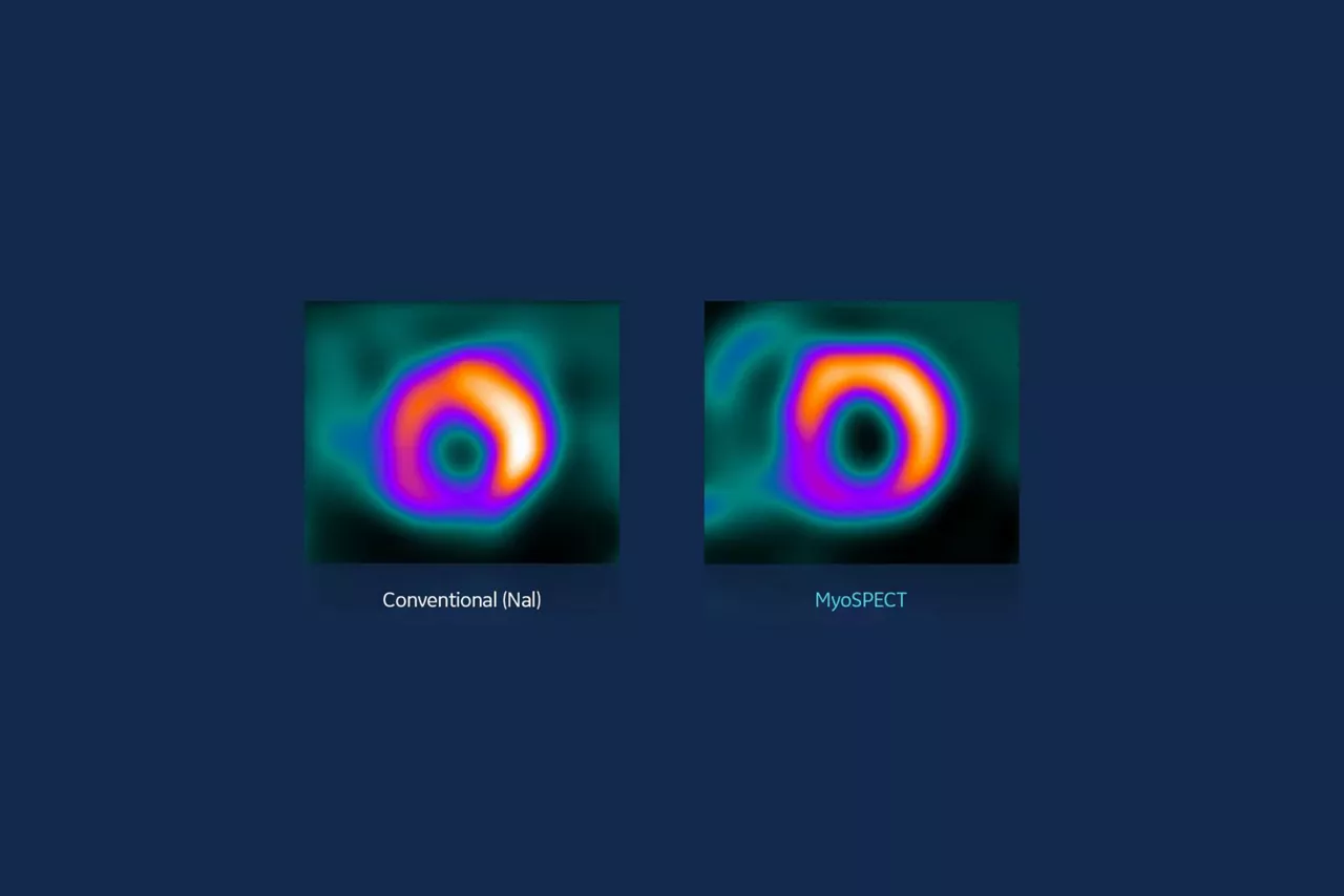 conventional-vs-myospect-ci-en