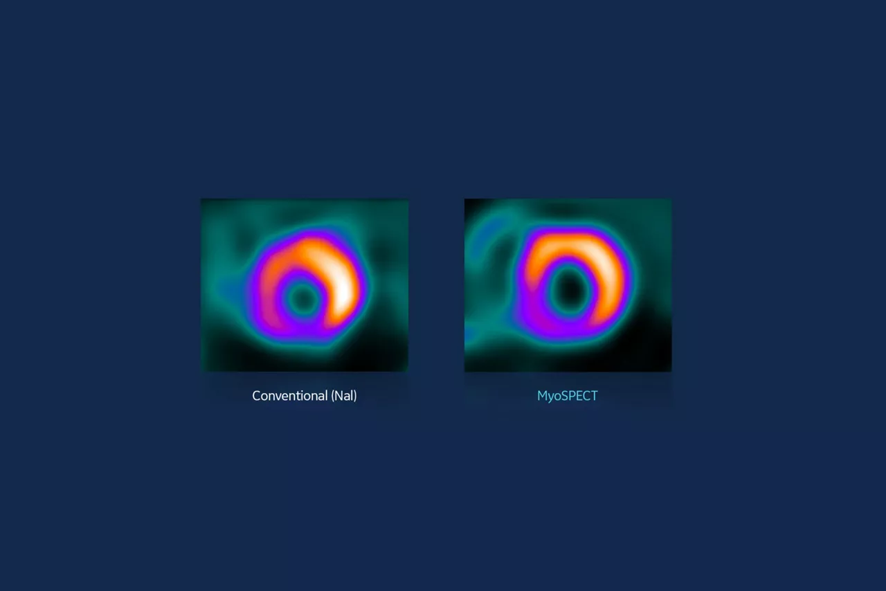 conventional-vs-myospect
