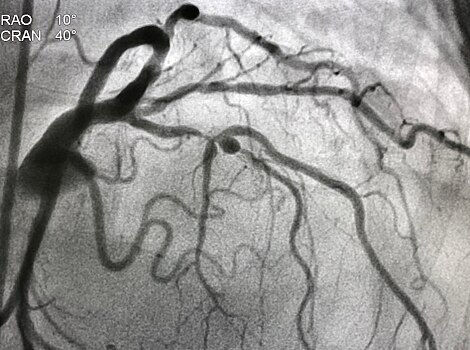 coronary-angiogram-shown-og-imge-ci-en