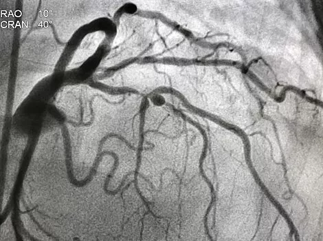 coronary-angiogram-shown-og-imge-ci-en
