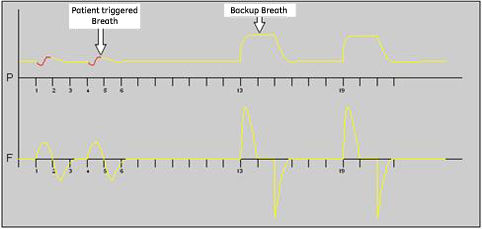 cpap