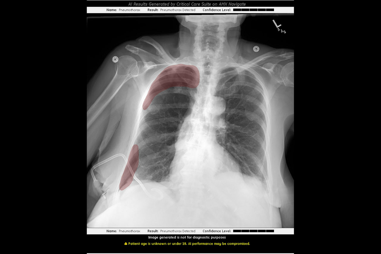 critical-care-suite-pneumothorax-vi-en