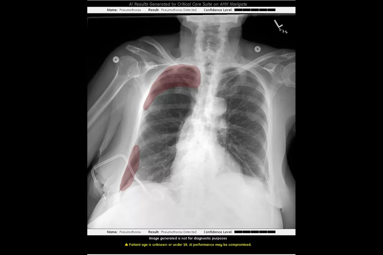 critical-care-suite-pneumothorax-vi-en