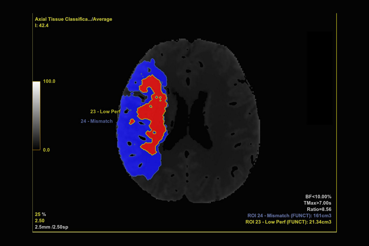 ct-perfusion-feature-ci-en