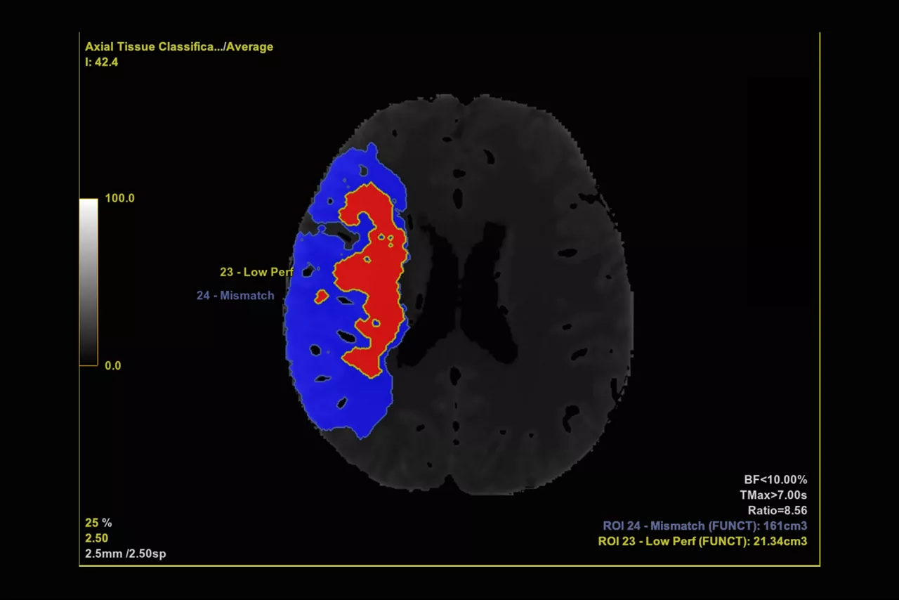 ct-perfusion-feature-ci-en