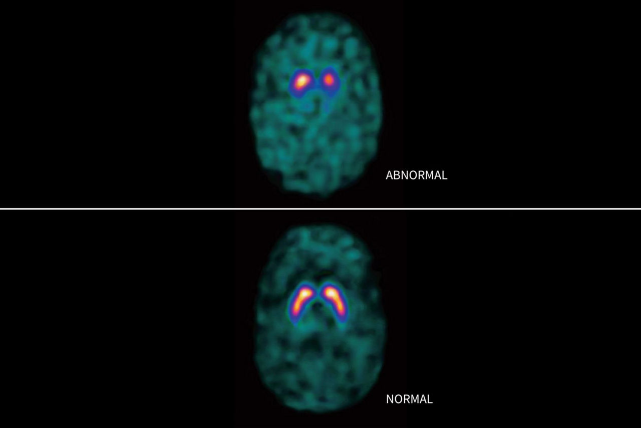 datscan-brain-scan