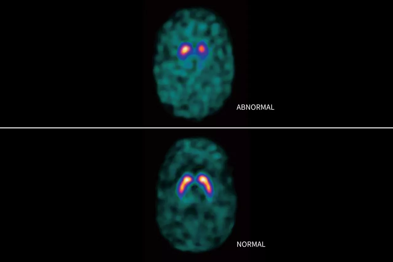 datscan-brain-scan