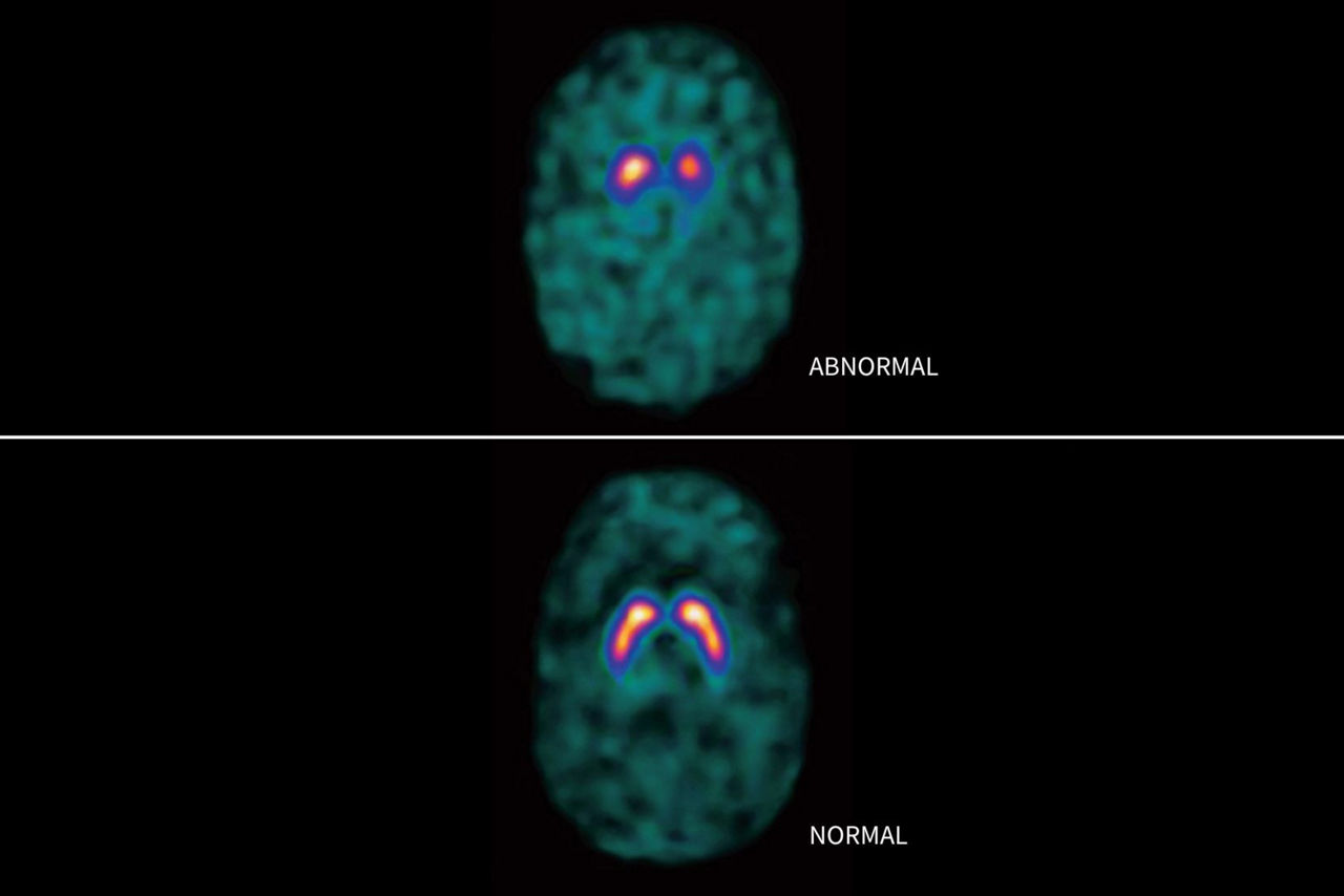 datscan-brain-scan-hero-sticky-scrolling-st-en