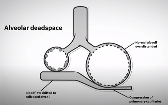 Deadspace-GasEx-LPV-ICU-THMB_560x353web_arc_global