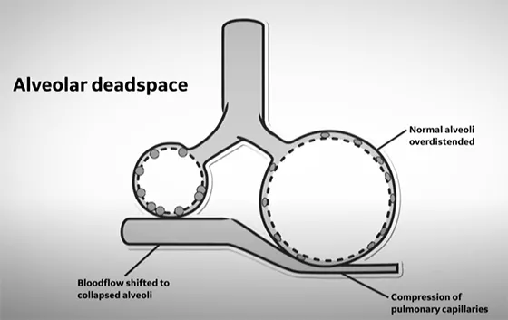 Deadspace-GasEx-LPV-ICU-THMB_560x353web_arc_global