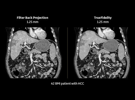 Deep-Learning-Image-Reconstruction-TrueFidelity-CT-Images-with-text