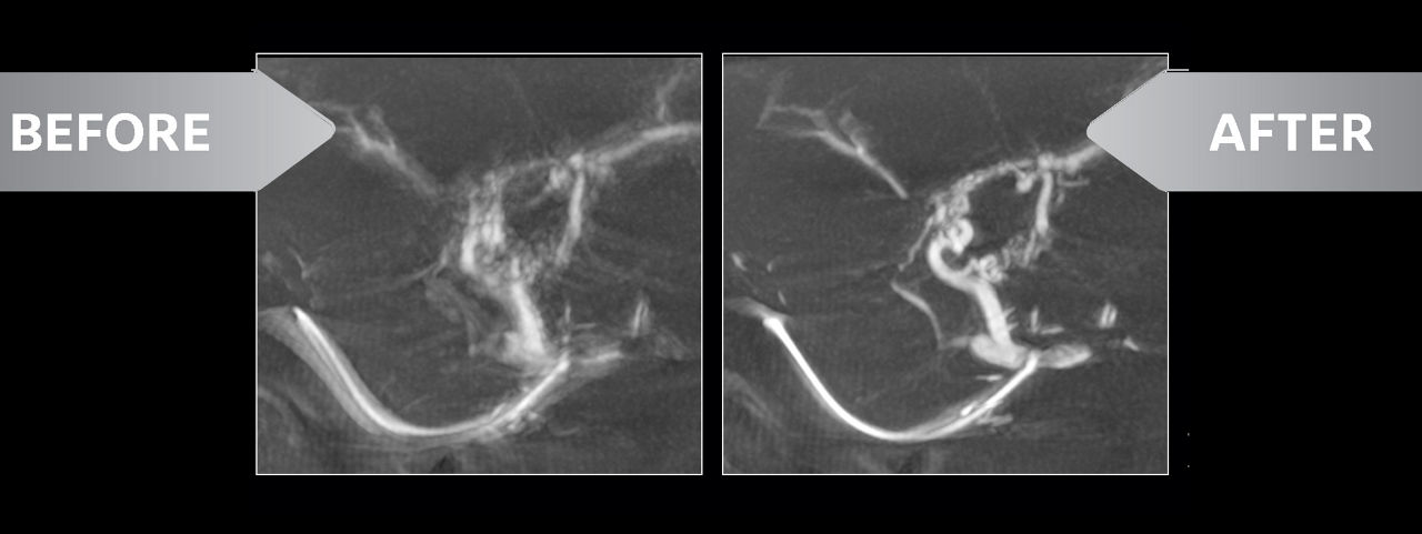 CBCT reconstruction affected by involuntary respiratory motion artifacts