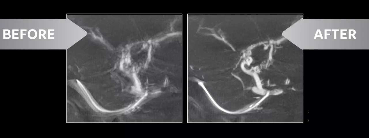 CBCT reconstruction affected by involuntary respiratory motion artifacts