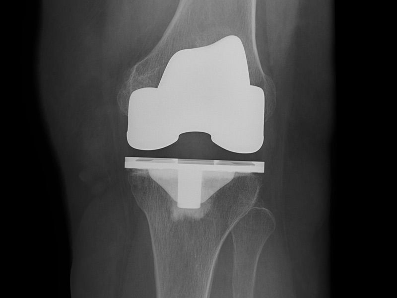 Discovery-656-excellent-handling-of-metal-implants-2columns