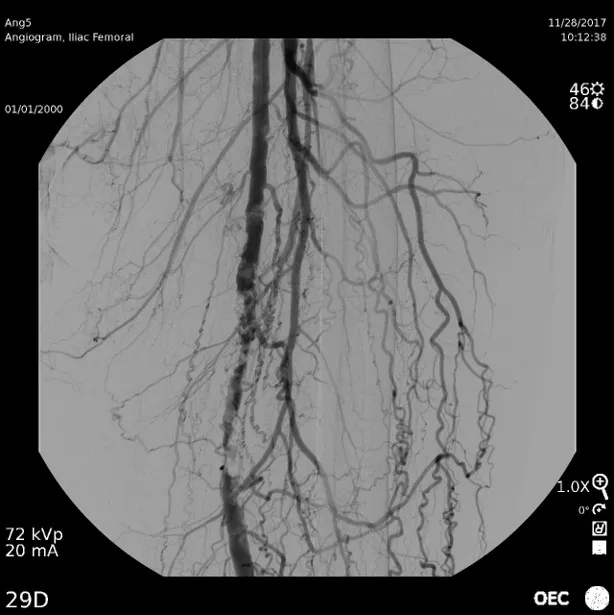Distal Femoral Angiogram